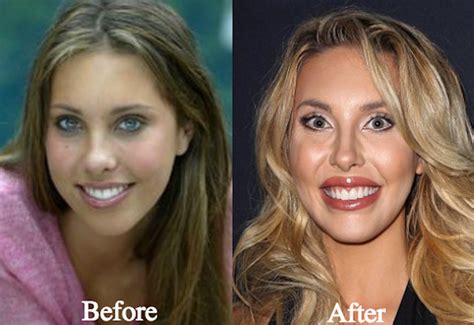 chloe lattanzi before surgery|Olivia Newton.